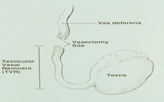  Taxa de gravidez – 31%Pasqualottoetal, J Urol, 1999,[object Object],[object Object]