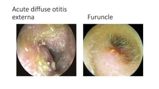 revesion of external and middle ear pathologies.pptx