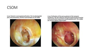 revesion of external and middle ear pathologies.pptx