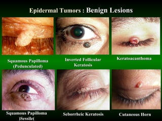 Inverted Seb K Review course in ocular oncology | PPS