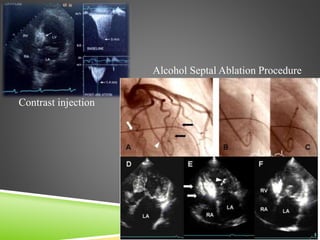 Septical Injection Septal Ablations Presentation | PPTX