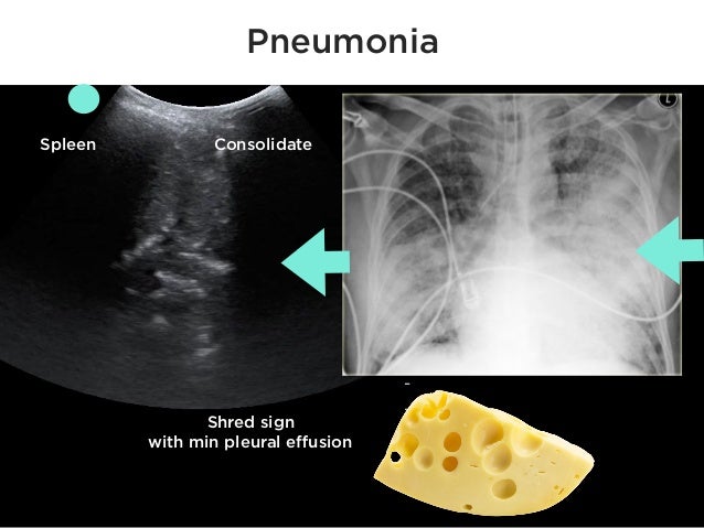 Review lung ultrasound