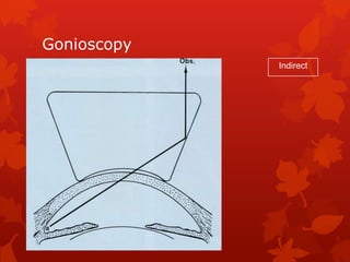 Review of angle closure glaucomas, By Fritz Allen, MD | PPTX
