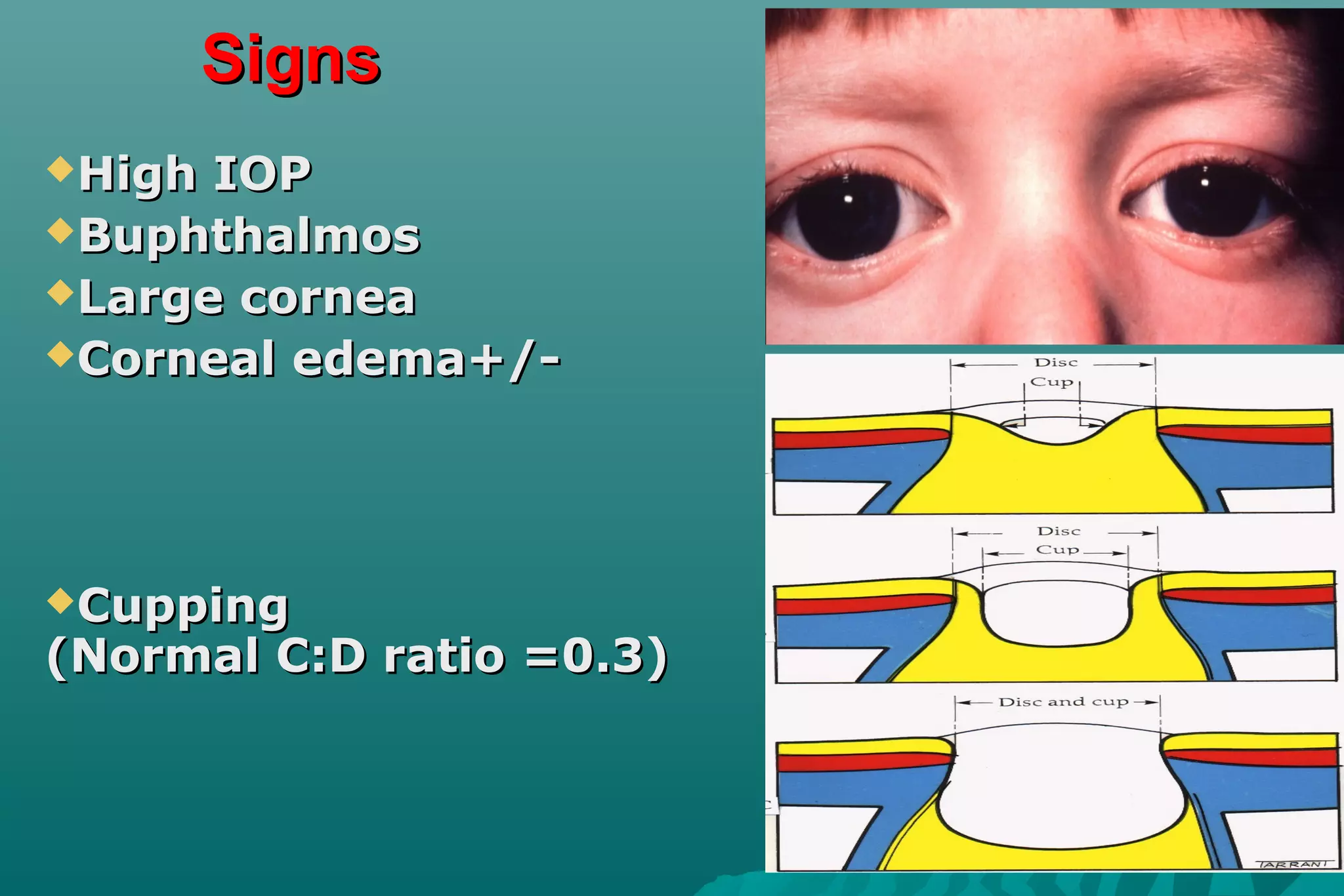 SignsSigns
High IOPHigh IOP
BuphthalmosBuphthalmos
Large corneaLarge cornea
Corneal edema+/-Corneal edema+/-
CuppingCupping
(Normal C:D ratio =0.3)(Normal C:D ratio =0.3)
 