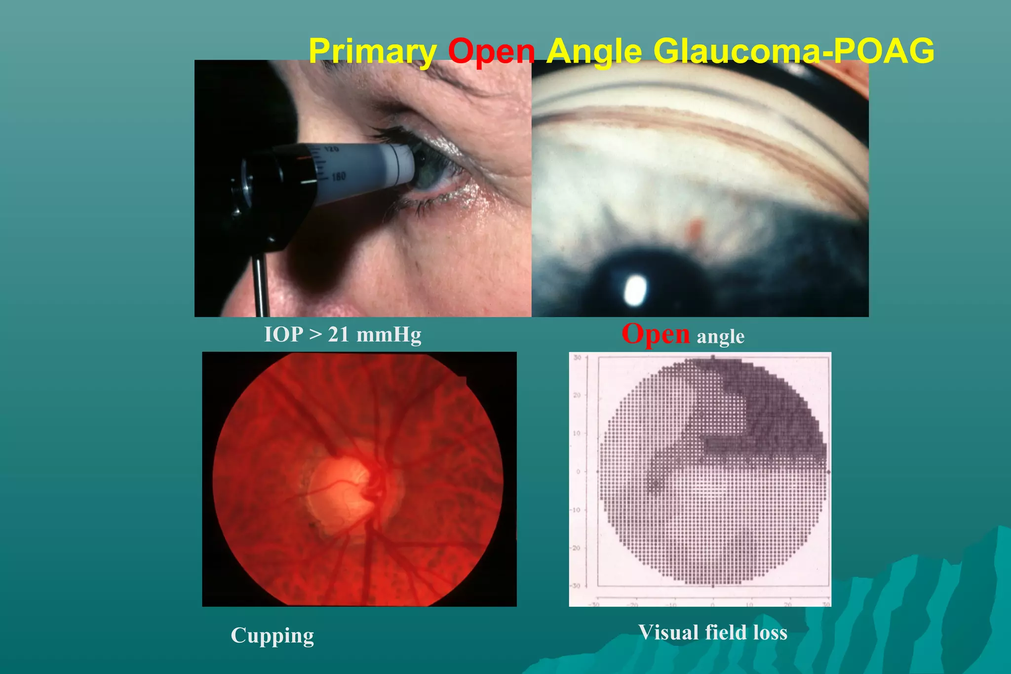 IOP > 21 mmHg
Cupping
Open angle
Visual field loss
Primary Open Angle Glaucoma-POAG
 