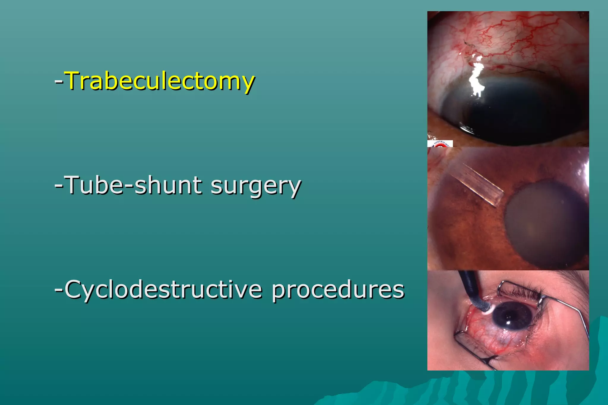 --TrabeculectomyTrabeculectomy
-Tube-shunt surgery-Tube-shunt surgery
-Cyclodestructive procedures-Cyclodestructive procedures
 