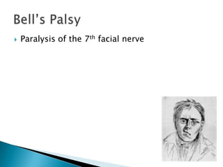 Paralysis of the 7th facial nerveBell’s Palsy 