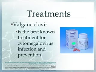 Treatments
Valganciclovir
is the best known
treatment for
cytomegalovirus
infection and
prevention
http://www.google.com.pr/imgres?um=1&hl=en&newwindow=1&sa=N&tbo=d&rlz=1C1TSNP_enPR481PR481&biw
=916&bih=531&tbm=isch&tbnid=CFUXNgrrqDS8vM:&imgre
url=http://drugline.org/drug/medicament/24183/&docid=YLjPNc2tzyWsBM&imgurl=http://drugline.org/img/drug/val
ganciclovir-
24183_1.jpg&w=500&h=391&ei=QdPAUMvMK4HP2QXhhYCAAw&zoom=1&iact=hc&vpx=157&vpy=110&dur=
609&hovh=199&hovw=254&tx=150&ty=134&sig=107306829355921645417&page=1&tbnh=144&tbnw=186&start=
0&ndsp=8&ved=1t:429,r:1,s:0,i:84
 
