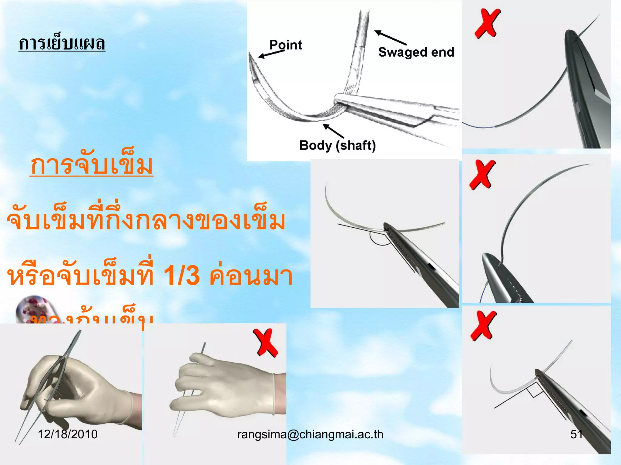 การเย็บแผล



  การจับเข็ม
จับเข็มที่ก่ งกลางของเข็ม
             ึ
หรือจับเข็มที่ 1/3 ค่ อนมา
  ทางก้ นเข็ม

   12/18/2010       rangsima@chiangmai.ac.th   51
 