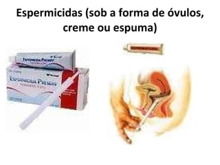 Espermicidas (sob a forma de óvulos, creme ou espuma) 