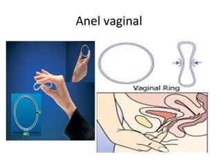 Anel vaginal  