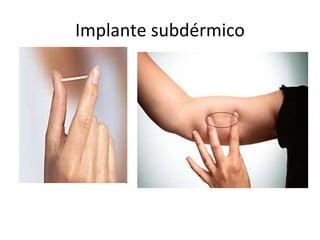 Implante subdérmico 
