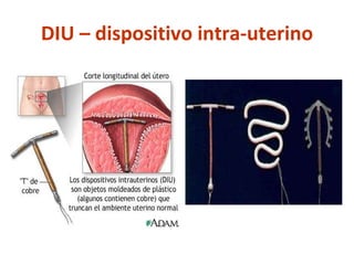 DIU – dispositivo intra-uterino 