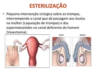 ESTERILIZAÇÃO Pequena intervenção cirúrgica sobre as trompas, interrompendo o canal que dá passagem aos óvulos na muIher (Laqueação de trompas) e dos espermatozóides no canal deferente do homem (Vasectomia).  