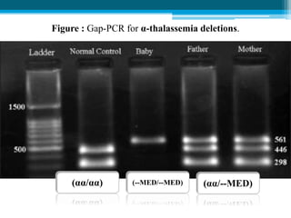 Figure : Gap-PCR for α-thalassemia deletions.
(αα/αα) (--MED/--MED) (αα/--MED)
 
