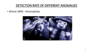 DETECTION RATE OF DIFFERENT ANOMALIES
• Almost 100% - Anencephaly.
16
 