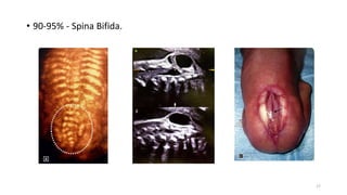 • 90-95% - Spina Bifida.
17
 