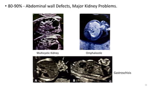 • 80-90% - Abdominal wall Defects, Major Kidney Problems.
Multicystic Kidney Omphalocele
Gastroschisis
18
 