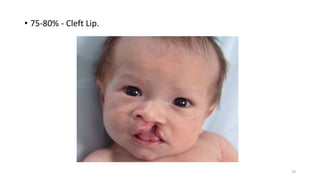 • 75-80% - Cleft Lip.
19
 