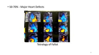 • 50-70% - Major Heart Defects
Tetralogy of Fallot
20
 