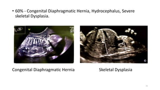• 60% - Congenital Diaphragmatic Hernia, Hydrocephalus, Severe
skeletal Dysplasia.
Congenital Diaphragmatic Hernia Skeletal Dysplasia
21
 