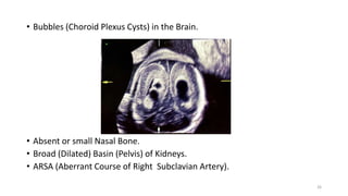 • Bubbles (Choroid Plexus Cysts) in the Brain.
• Absent or small Nasal Bone.
• Broad (Dilated) Basin (Pelvis) of Kidneys.
• ARSA (Aberrant Course of Right Subclavian Artery).
26
 