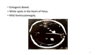 • Echogenic Bowel.
• White spots in the Heart of Fetus.
• Mild Ventriculomegaly.
27
 