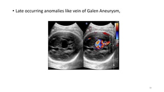• Late occurring anomalies like vein of Galen Aneurysm,
38
 