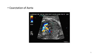• Coarctation of Aorta
39
 