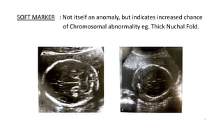 SOFT MARKER : Not itself an anomaly, but indicates increased chance
of Chromosomal abnormality eg. Thick Nuchal Fold.
5
 