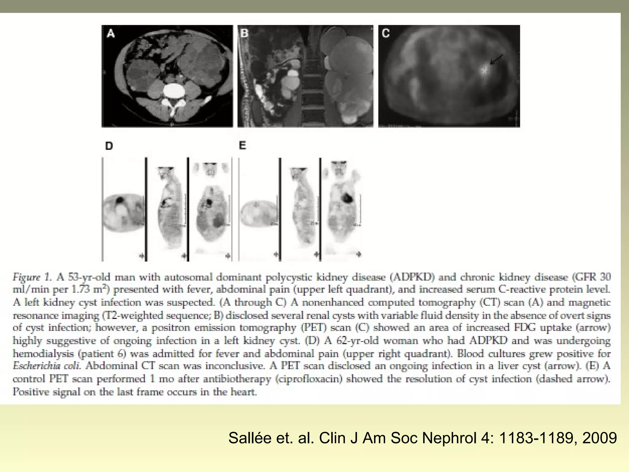 Sallée et. al. Clin J Am Soc Nephrol 4: 1183-1189, 2009
 