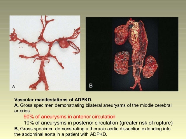 autosomal dominant polycystic kidney disease Detailed information on the different types of polycystic kidney disease, including autosomal dominant polycystic kidney disease, autosomal recessive polycystic kidney disease, and acquired cystic kidney disease. autosomal dominant polycystic kidney disease Detailed information on the different types of polycystic kidney disease, including autosomal dominant polycystic kidney disease, autosomal recessive polycystic kidney disease, and acquired cystic kidney disease.