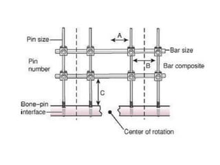 Principles of external fixation | PDF