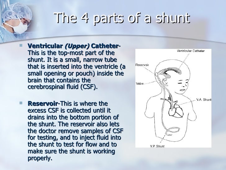 Hydrocephalus and Shunts Sean's Story
