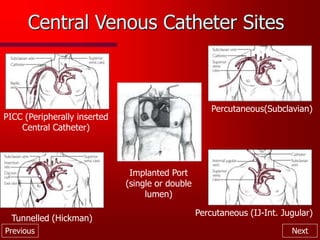 Previous Next
Central Venous Catheter Sites
PICC (Peripherally inserted
Central Catheter)
Percutaneous(Subclavian)
Percutaneous (IJ-Int. Jugular)
Tunnelled (Hickman)
Implanted Port
(single or double
lumen)
 