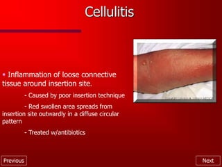 Previous Next
Cellulitis
 Inflammation of loose connective
tissue around insertion site.
- Caused by poor insertion technique
- Red swollen area spreads from
insertion site outwardly in a diffuse circular
pattern
- Treated w/antibiotics
 
