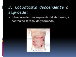 3. Colostomía descendente o
sigmoide:
 Situada en la zona izquierda del abdomen; su
contenido será sólido y formado.
 