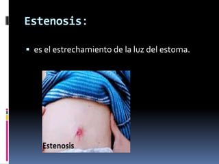 Estenosis:
 es el estrechamiento de la luz del estoma.
 