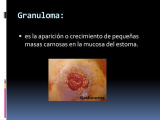 Granuloma:
 es la aparición o crecimiento de pequeñas
masas carnosas en la mucosa del estoma.
 