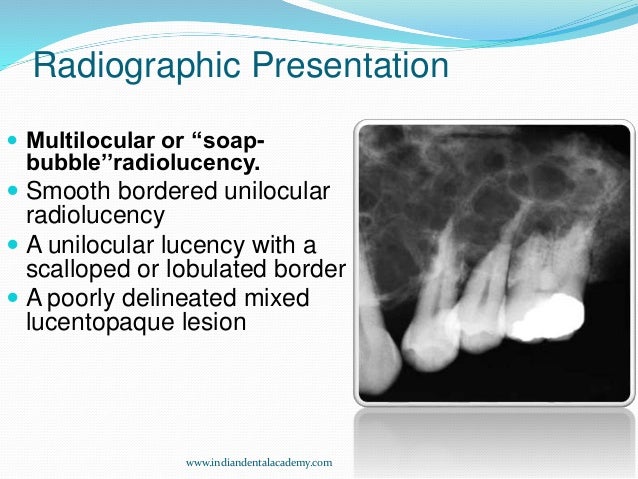 Ameloblastoma ,odontogenic tumors/ dental courses