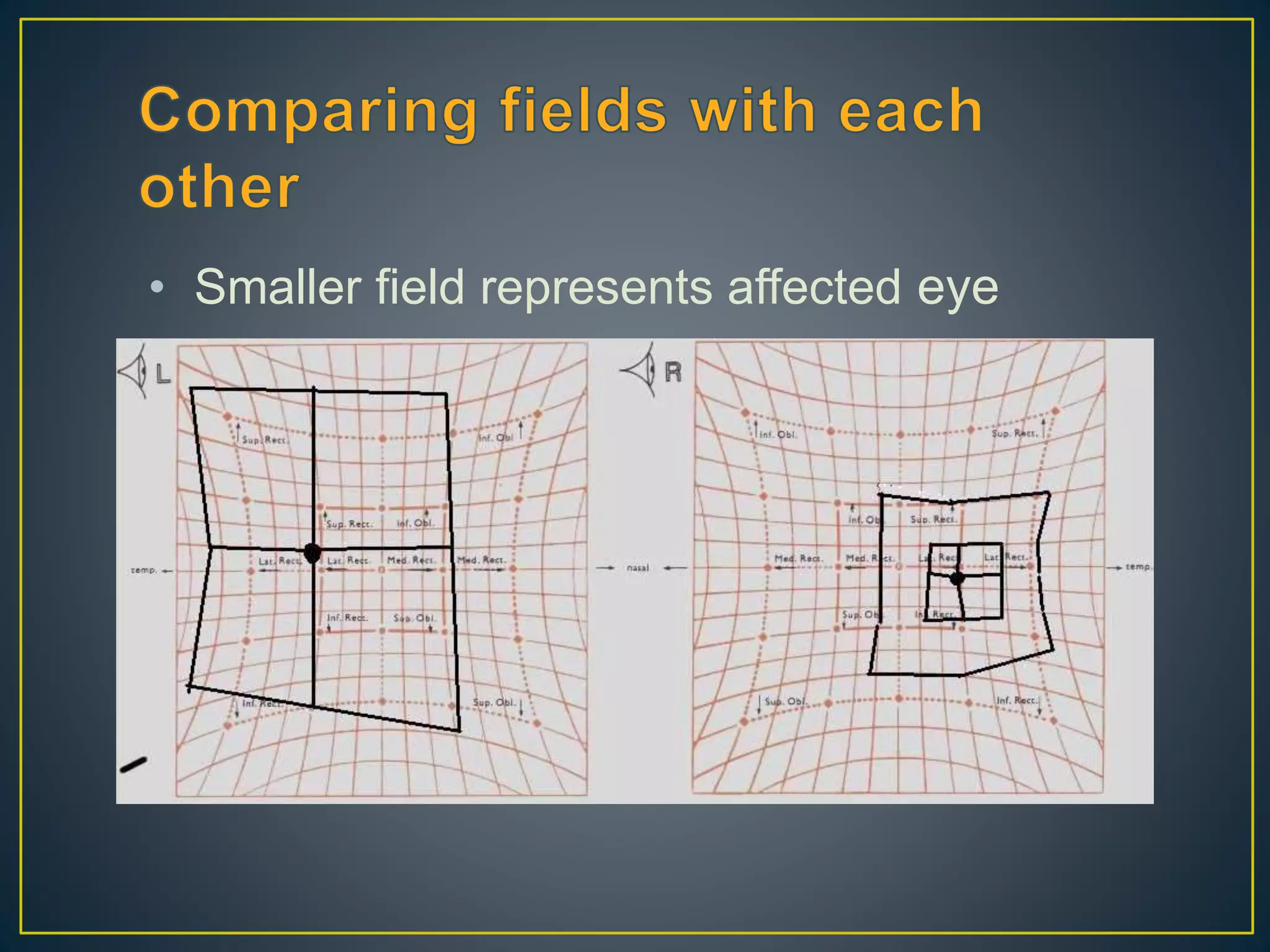 • Smaller field represents affected eye
• Incomitance suggests recent onset
 
