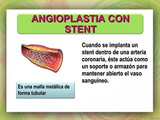 AANNGGIIOOPPLLAASSTTIIAA CCOONN 
SSTTEENNTT 
CCuuaannddoo ssee iimmppllaannttaa uunn 
sstteenntt ddeennttrroo ddee uunnaa aarrtteerriiaa 
ccoorroonnaarriiaa,, ééssttee aaccttúúaa ccoommoo 
uunn ssooppoorrttee oo aarrmmaazzóónn ppaarraa 
mmaanntteenneerr aabbiieerrttoo eell vvaassoo 
ssaanngguuíínneeoo.. 
EEss uunnaa mmaallllaa mmeettáálliiccaa ddee 
ffoorrmmaa ttuubbuullaarr 
 