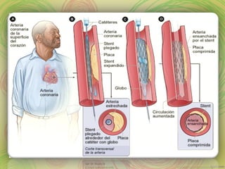 Cateterismo cardiaco y Angioplastia