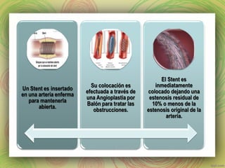 Cateterismo cardiaco y Angioplastia