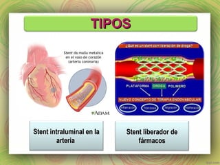 TTIIPPOOSS 
SStteenntt iinnttrraalluummiinnaall eenn llaa 
aarrtteerriiaa 
SStteenntt lliibbeerraaddoorr ddee 
ffáárrmmaaccooss 
 