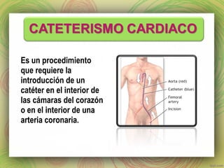Es un procedimiento 
que requiere la 
introducción de un 
catéter en el interior de 
las cámaras del corazón 
o en el interior de una 
arteria coronaria. 
 