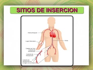 SSIITTIIOOSS DDEE IINNSSEERRCCIIOONN 
 