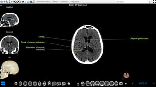 Revision for brain cross-sectional anatomy | PPTX