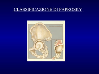 CLASSIFICAZIONE DI PAPROSKY

 