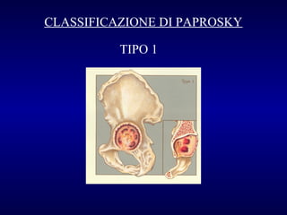 CLASSIFICAZIONE DI PAPROSKY
TIPO 1

 
